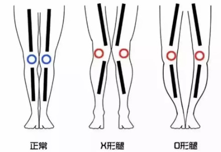 5个少儿常见不良体态，最后一个可能会毁了孩子一生……