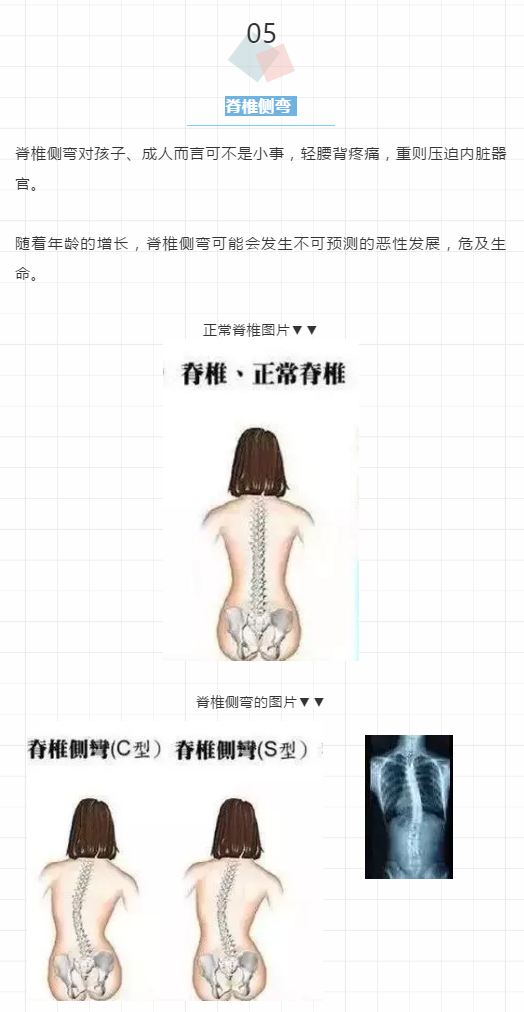 5个少儿常见不良体态，最后一个可能会毁了孩子一生......