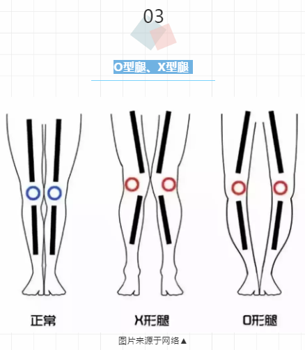 5个少儿常见不良体态，最后一个可能会毁了孩子一生......