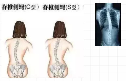 5个少儿常见不良体态，最后一个可能会毁了孩子一生……